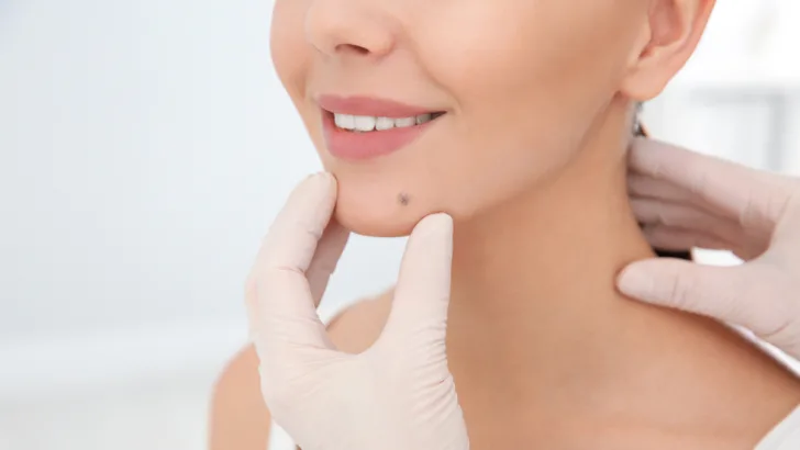 Birthmarks